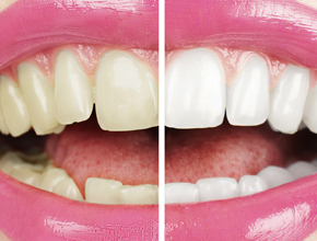 Stomatološki centar - Izbjeljivanje zuba